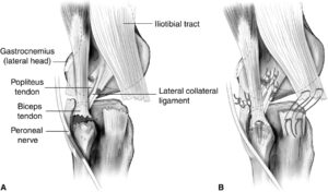 posterolateral-corner-injury