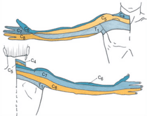 cervical radiculopathy