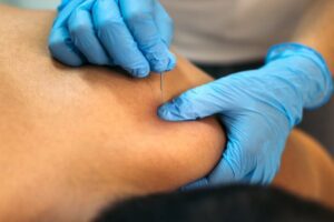 Physioherapist administering dry needling by inserting a needle into a patient's muscle