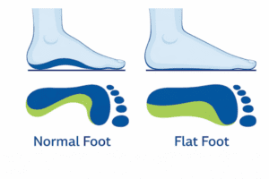 Flat feet pes planus footprint comparison showing low arch contact pattern