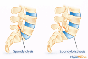 Spondylolisthesis physiotherapy lumbar spine slip comparison diagram