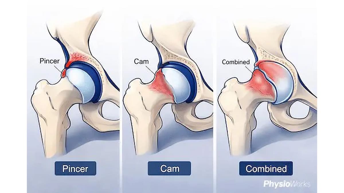Femoroacetabular impingement syndrome showing cam pincer and mixed hip joint patterns.