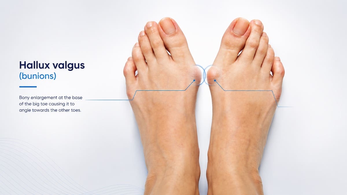 Feet showing hallux valgus with bunion prominences at the big toe joints